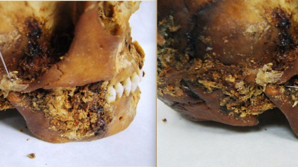 Iron Age Surgeons Fixed a Woman's Shattered Jaw With Primitive Prosthetic—and She Survived